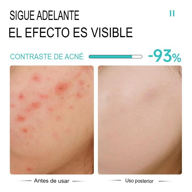 (2X1) Crema Anti Acné "Bioaqua"