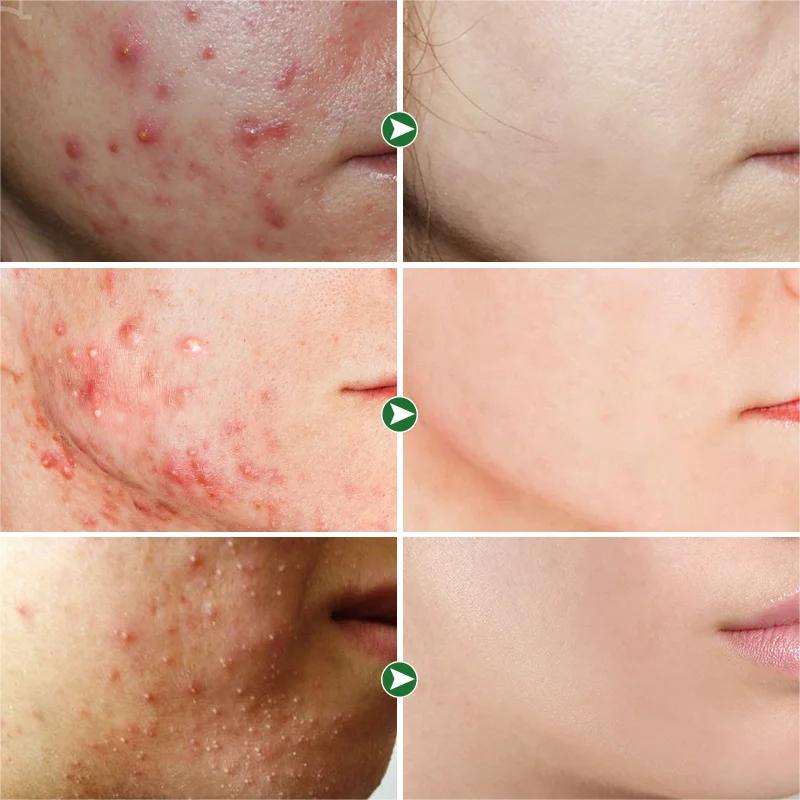 (2X1) Crema Anti Acné "Bioaqua"